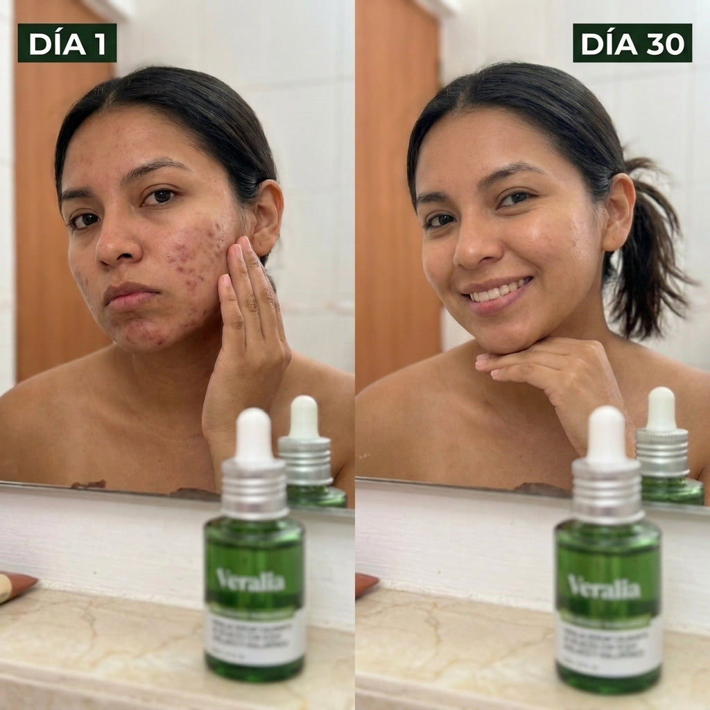 Veralia™ Sérum Azelaico para Manchas y Rojeces de Acné