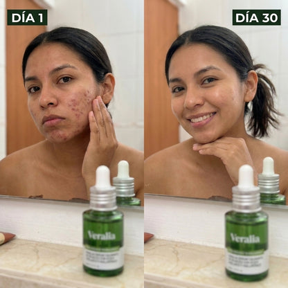 Veralia™ Sérum Azelaico para Manchas y Rojeces de Acné